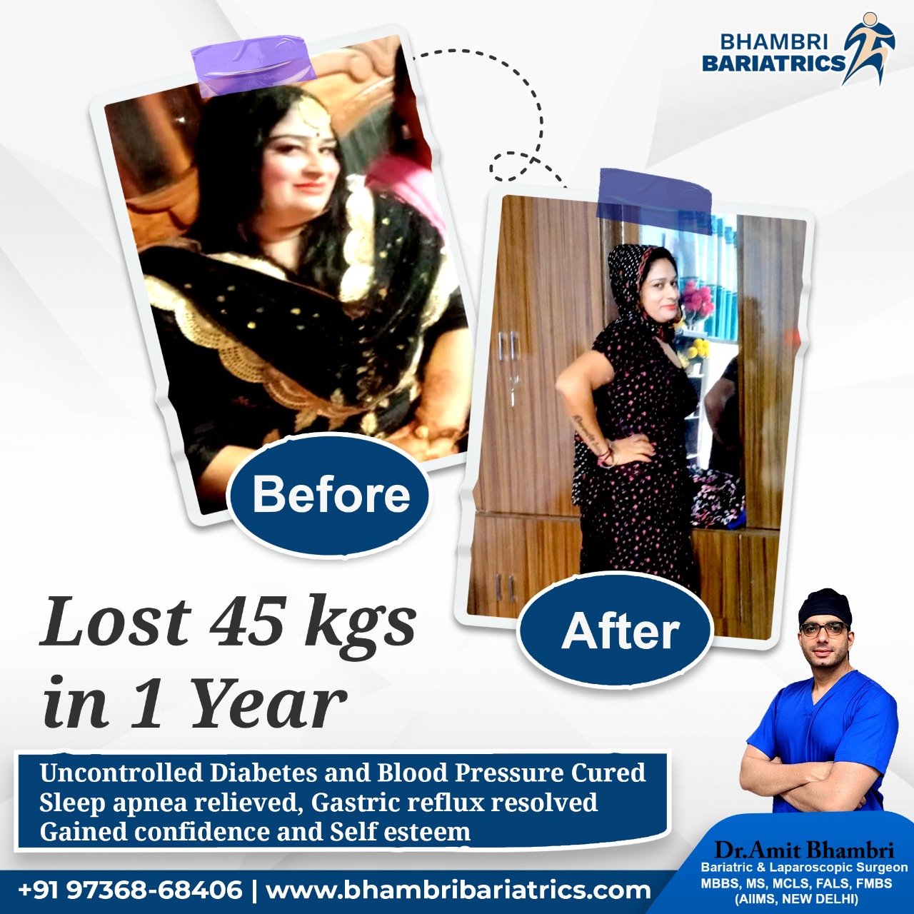 Bariatric surgery patient transformation